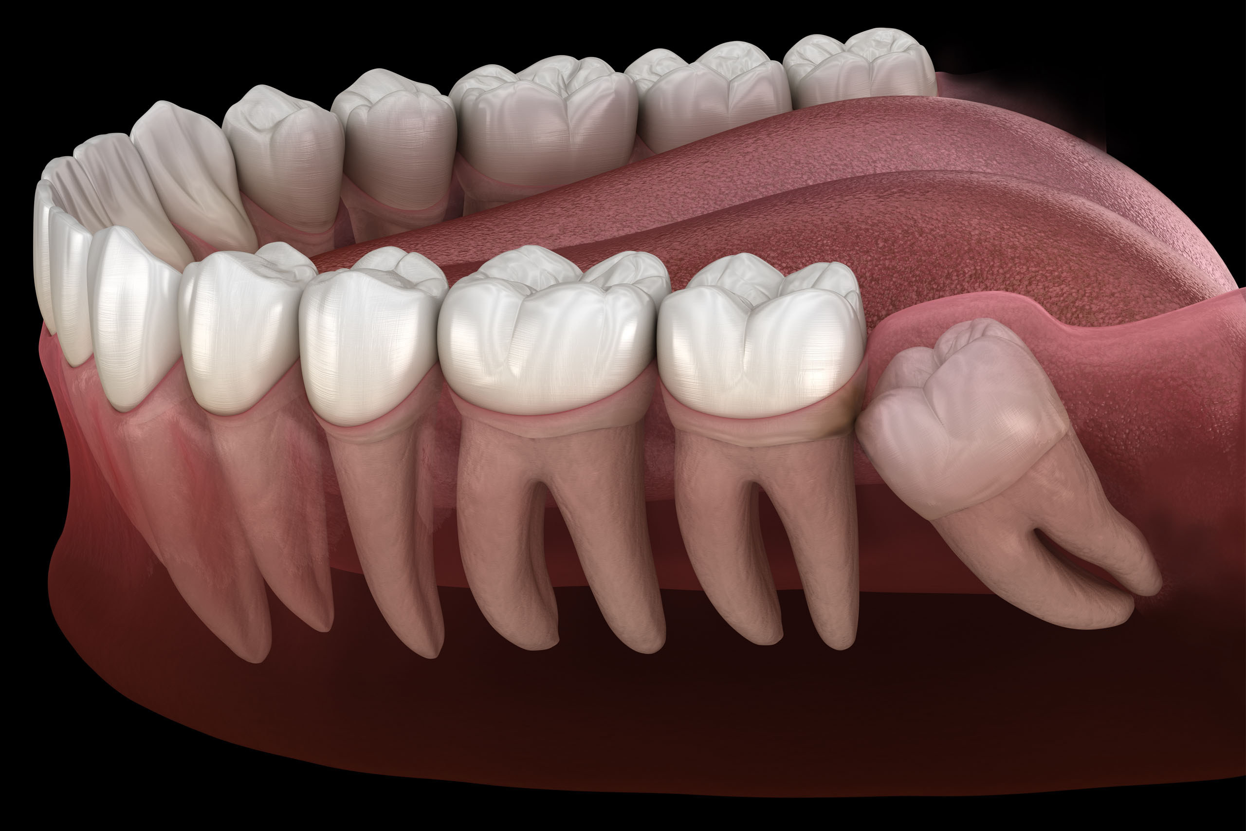 A computer rendering of wisdom teeth in the mouth