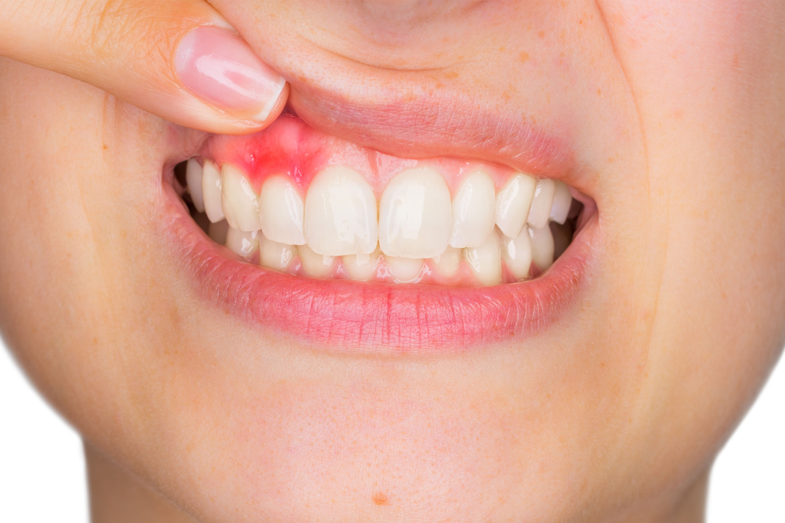 Why Are My Gums Receding?
