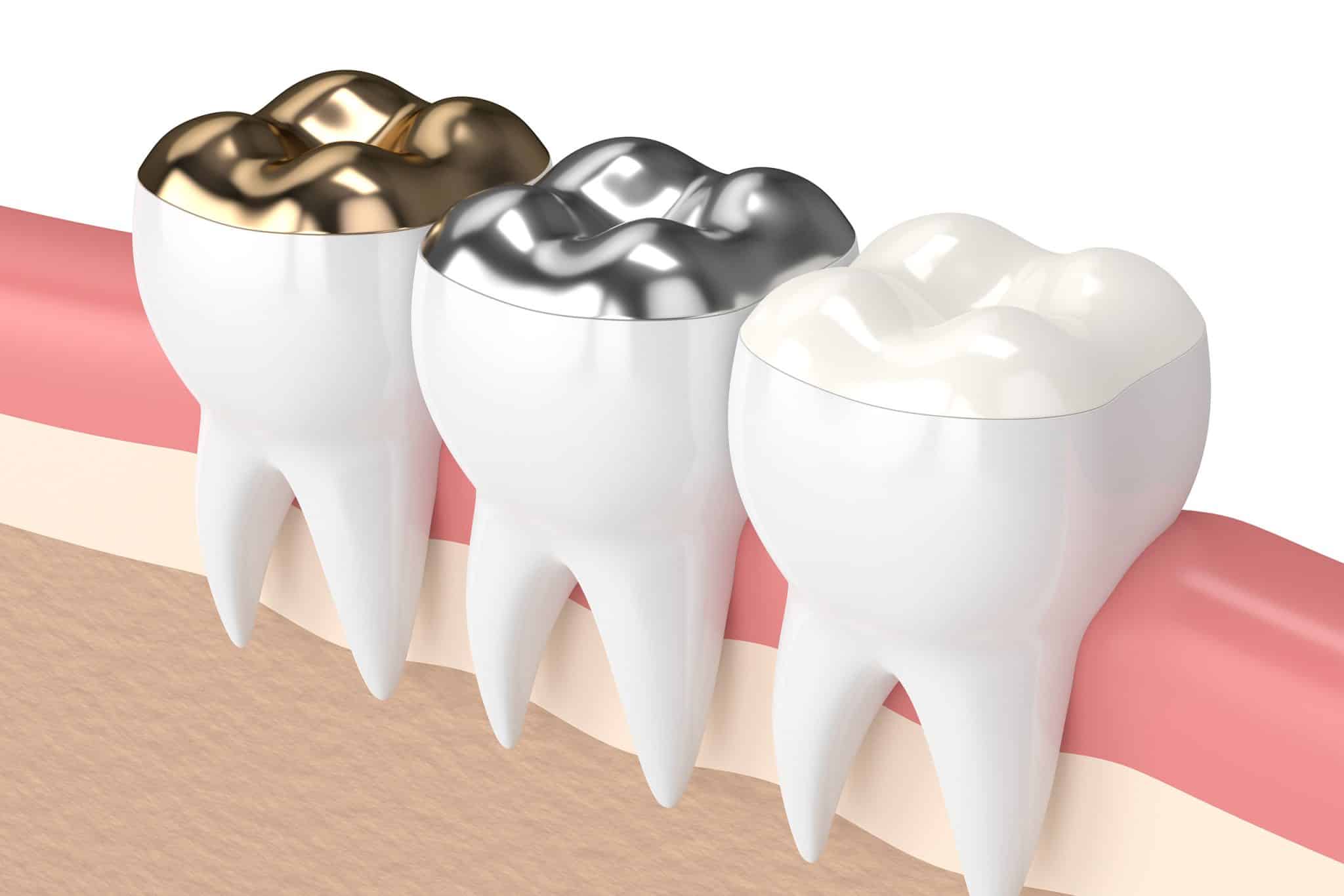 A computer rendering of a dental onlay