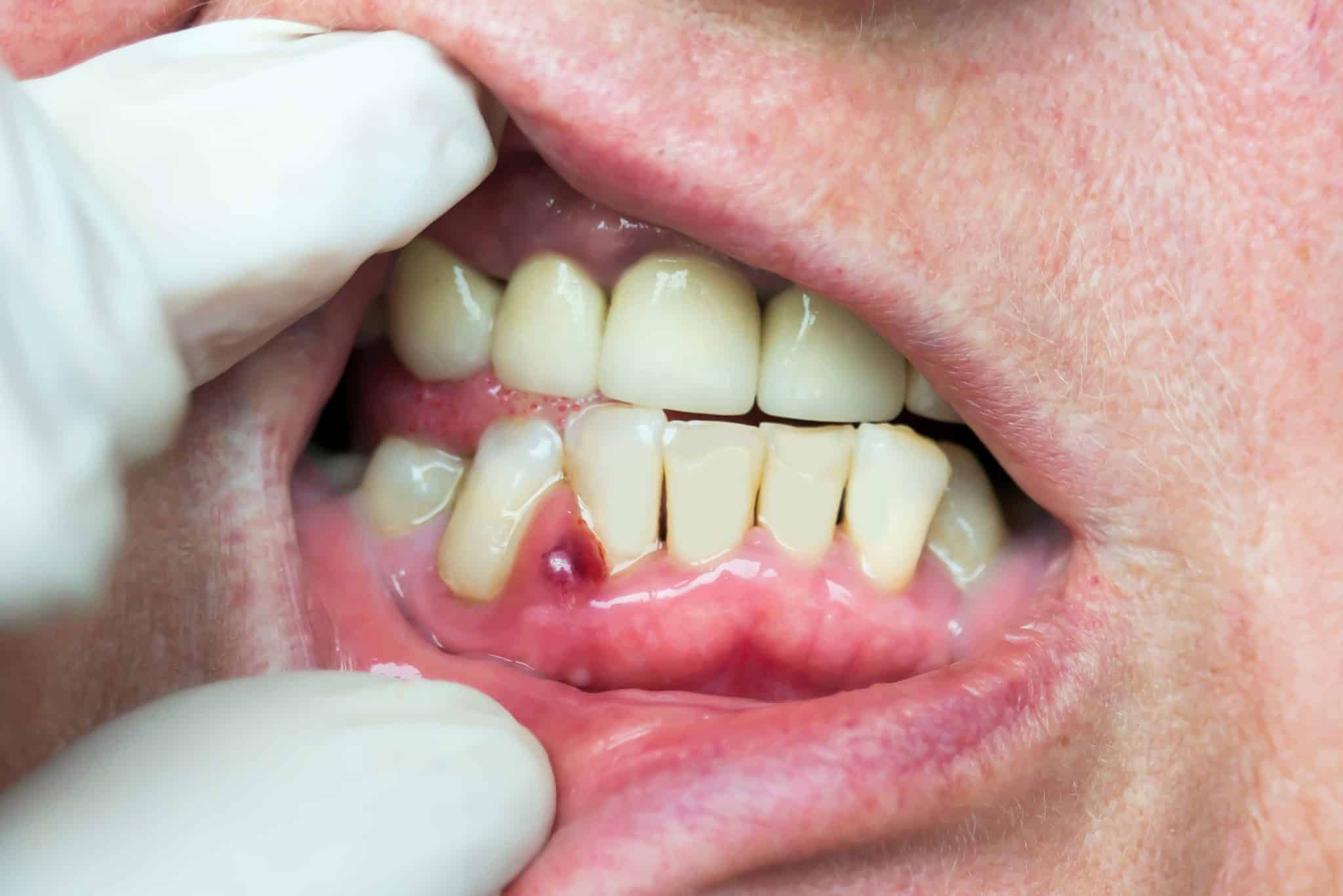 A photo of a man's mouth with a gum abscess