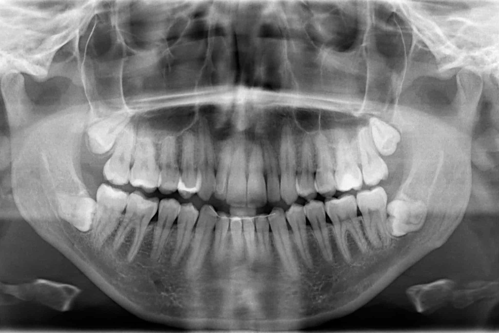 An x-ray of a mouth with wisdom teeth.