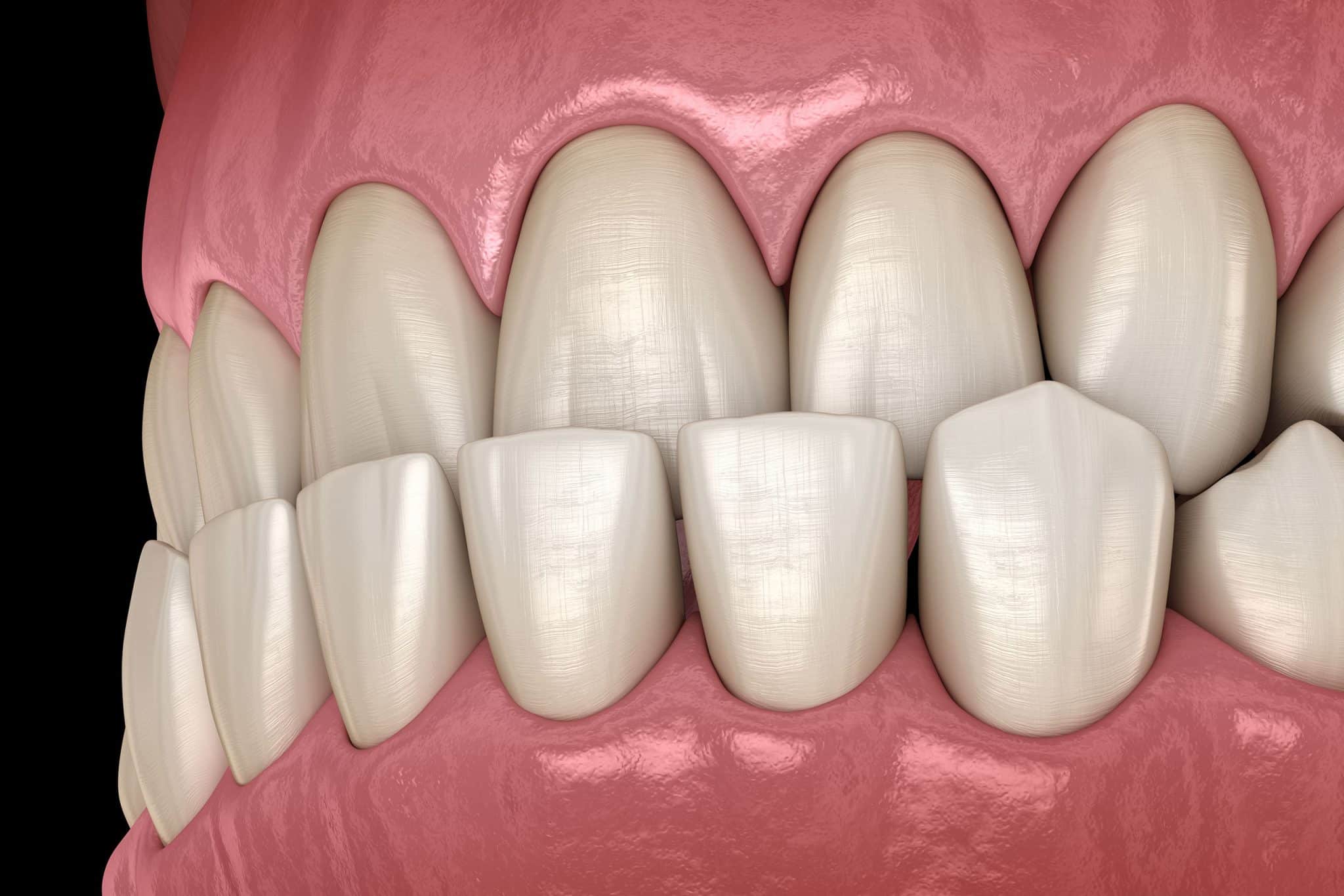 Everything You Need to Know About an Underbite - Online Dental Care