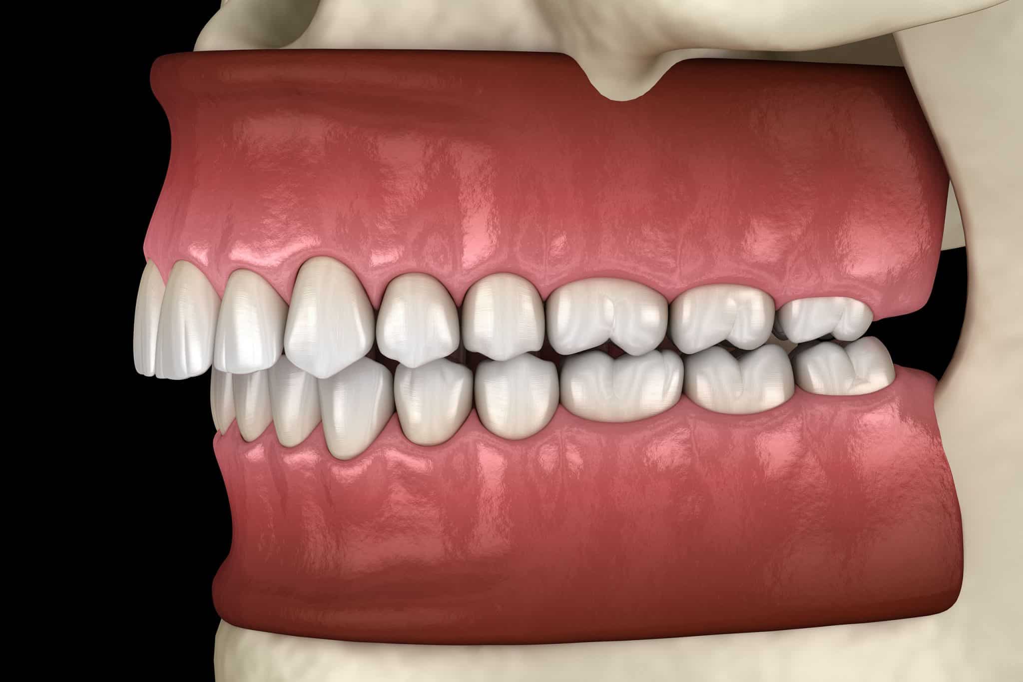 A rendering of an overbite