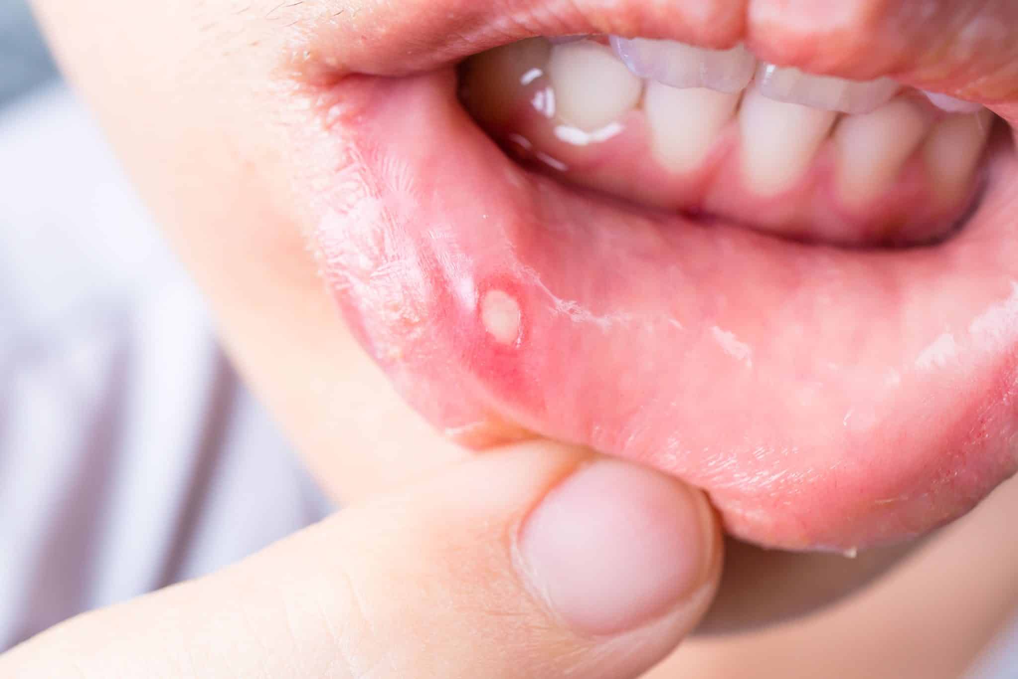 A photo of a canker sore on the inside of someones lip