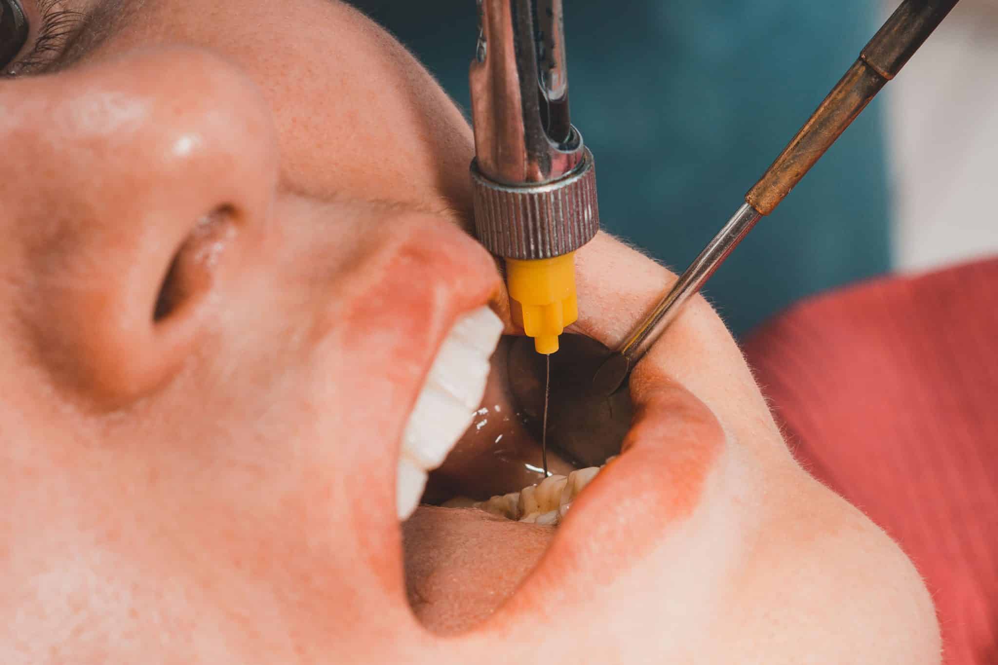 Young person getting a local anesthetic at a dental office