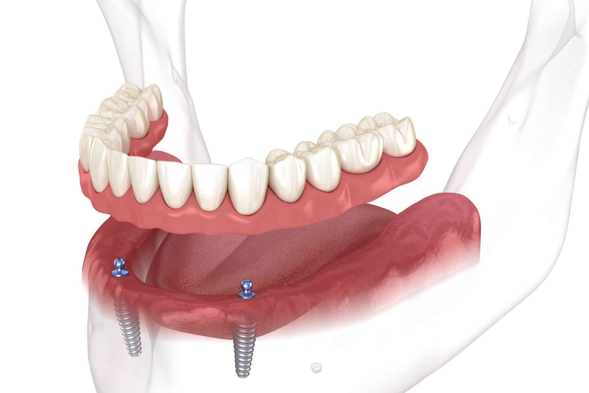 A 3d rendering of how snap on dentures are placed