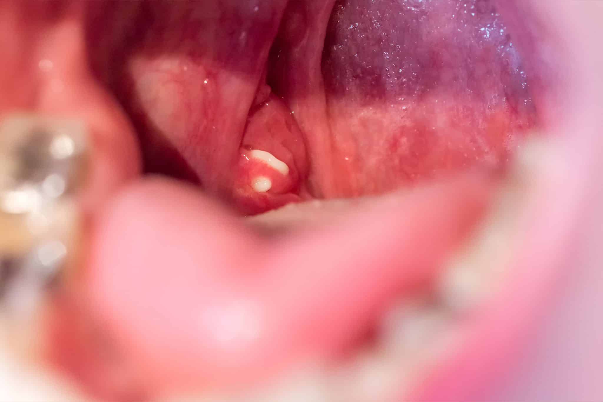 A photo of a tonsil stone inside of a mouth