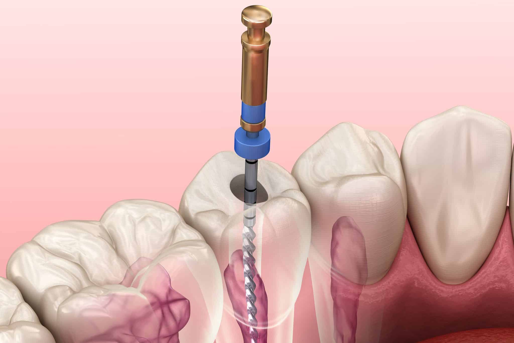 A rendering of a root canal procedure.