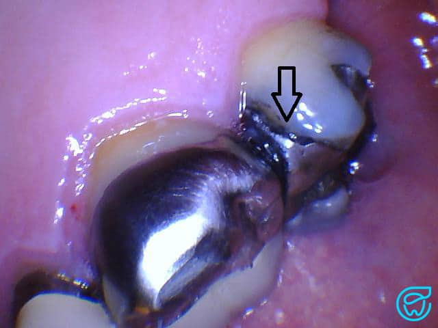 Image showing a failing dental restoration, specifically a marginal breakdown.