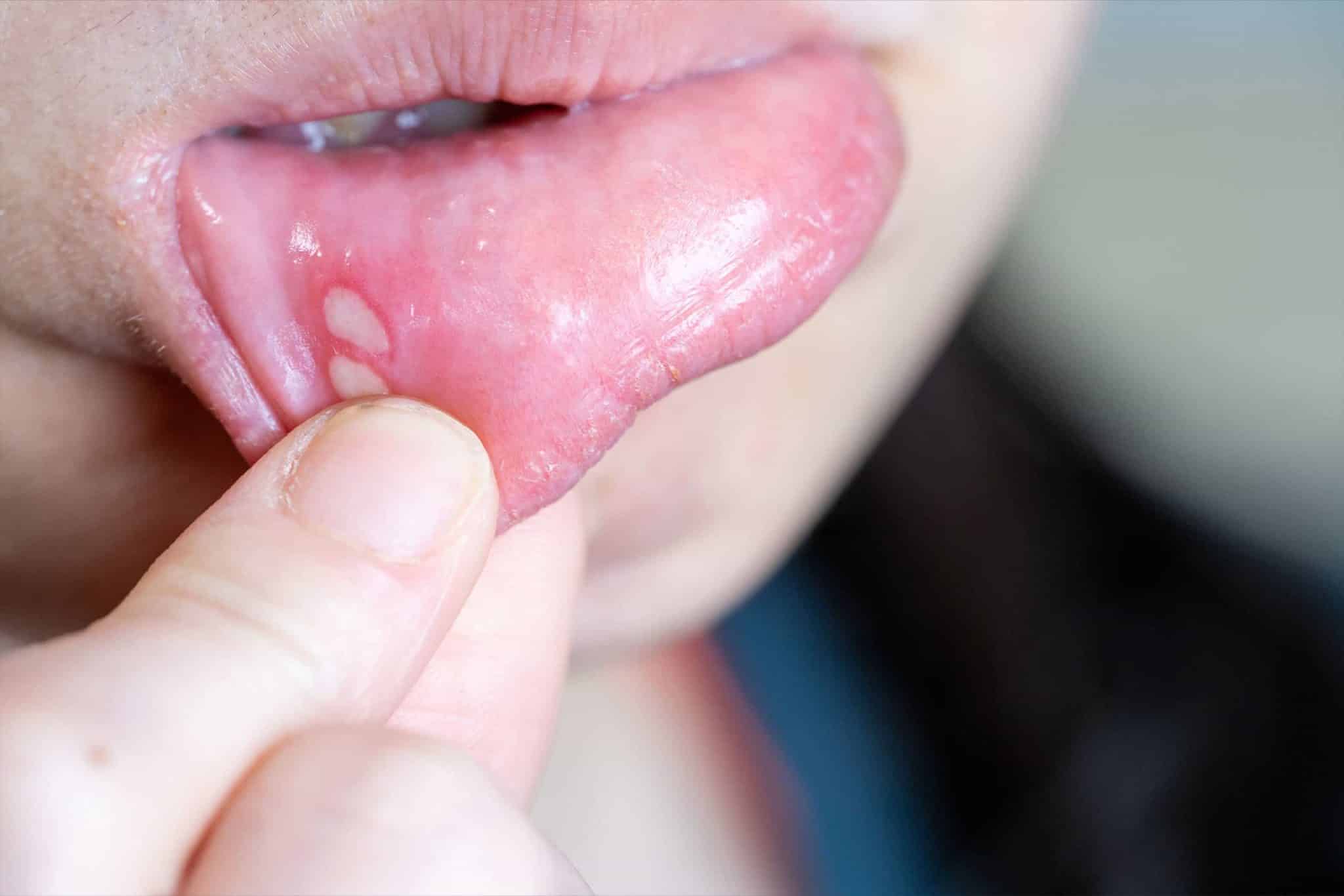 A woman pulling her lip to show two of her canker sores.