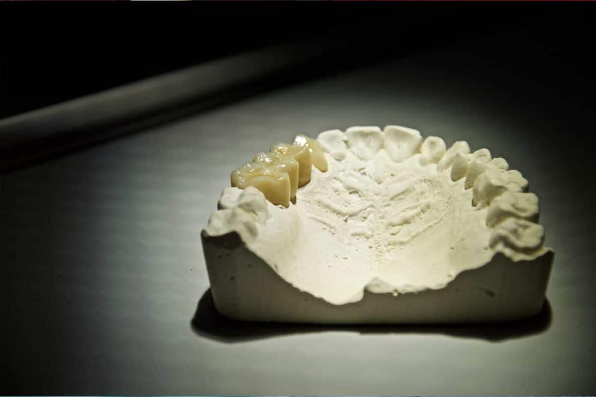 A picture of a dental mold showing a dental bridge.