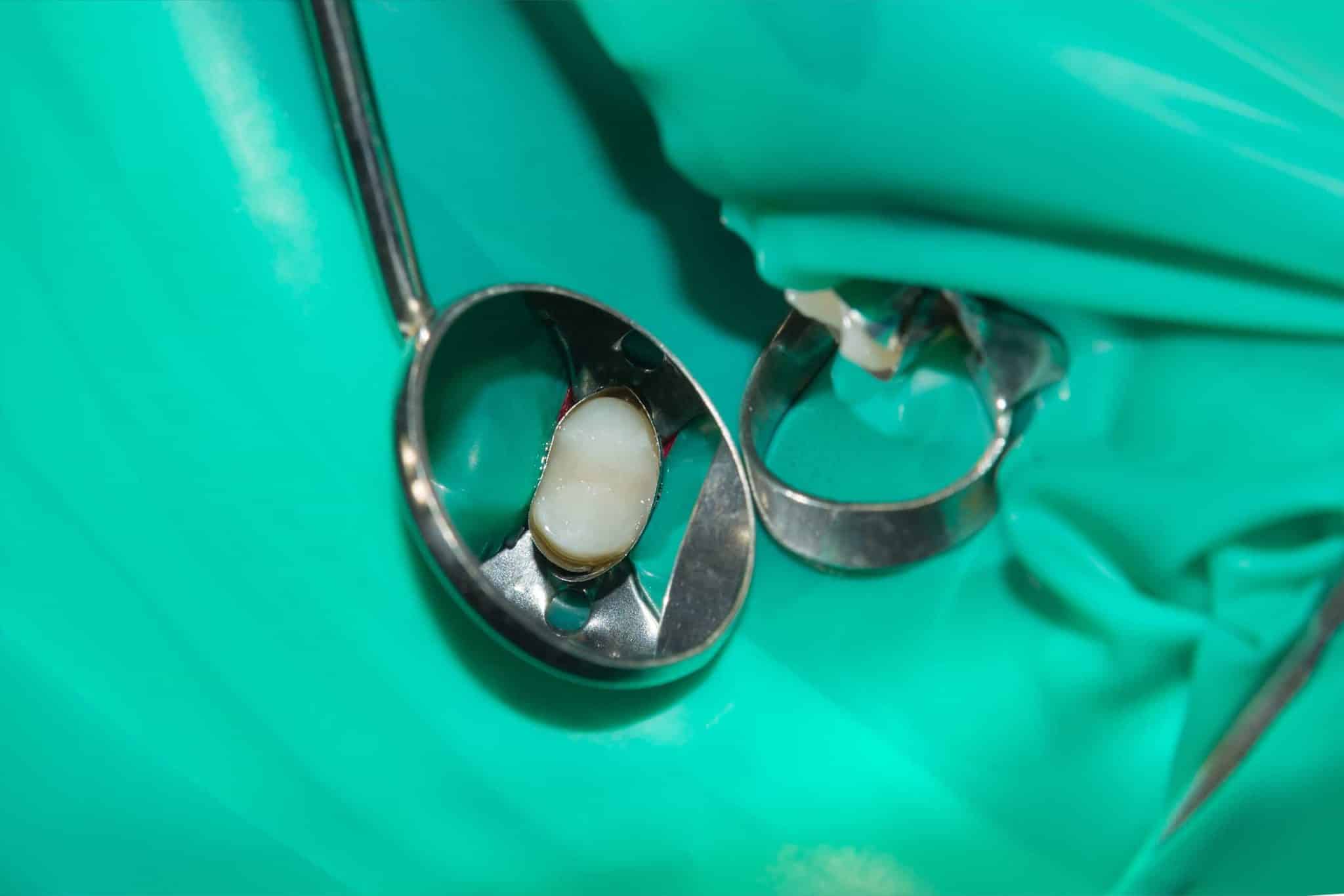 A picture of a tooth getting being prepped for a root canal.