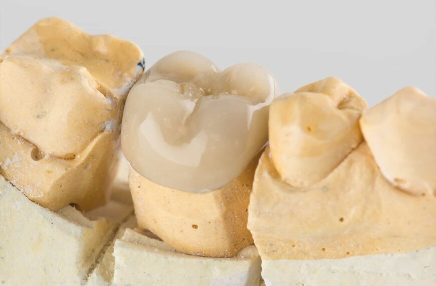 A picture of a tooth mold with a ceramic crown.