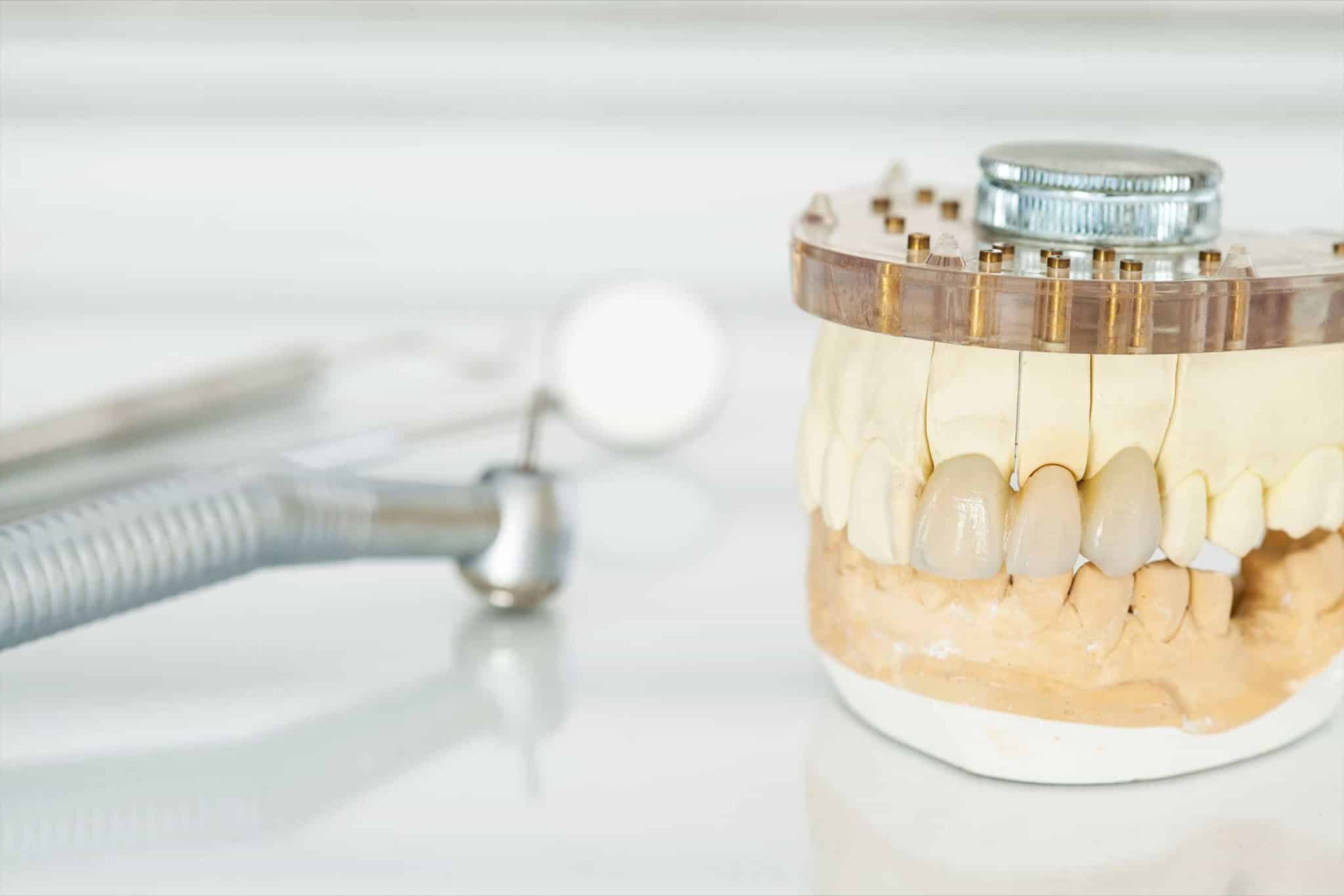 A picture showing some ceramic crowns on a tooth mold.