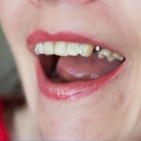 A picture of a woman with a dental implant anchor, but no tooth placed yet.