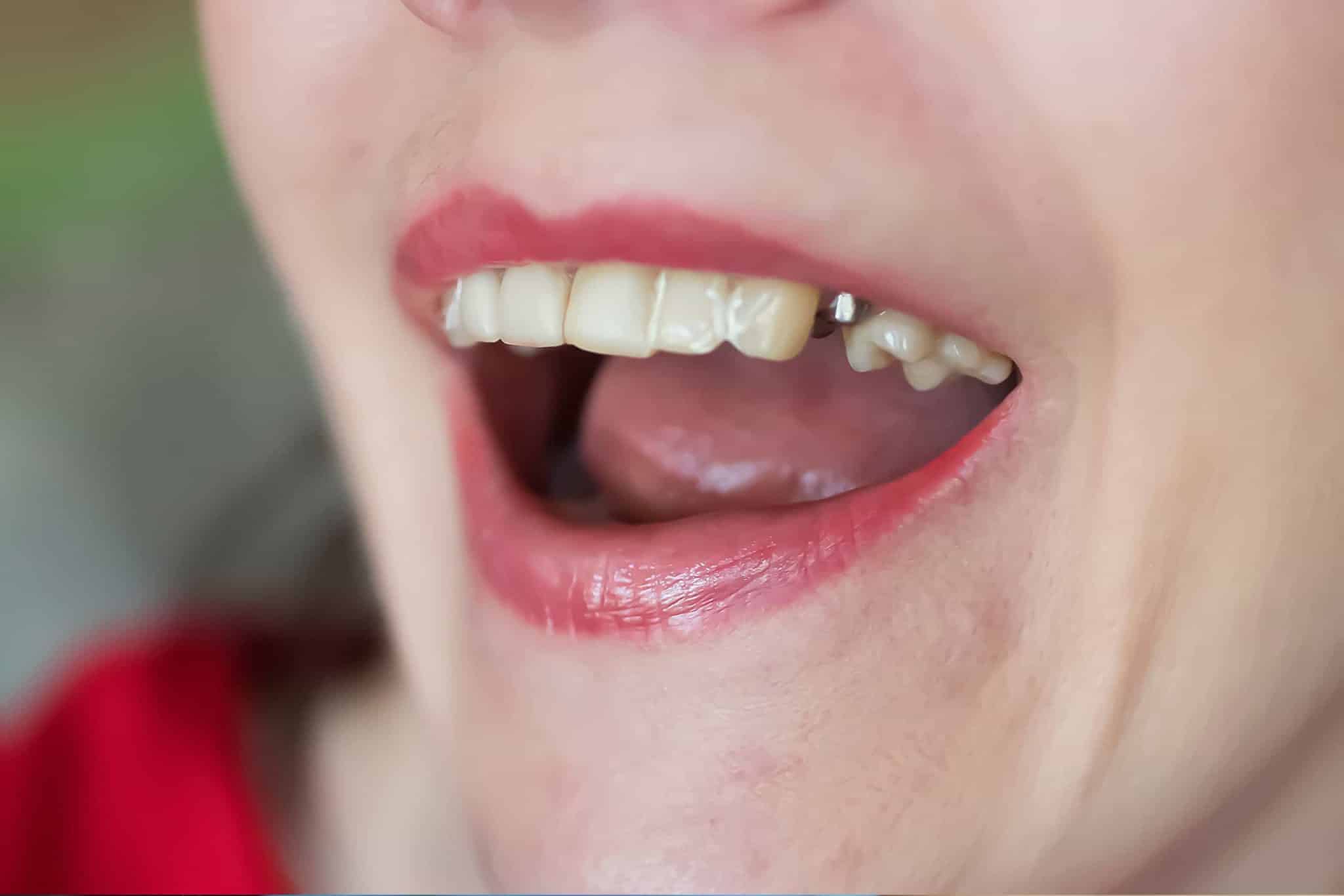 A picture of a woman with a dental implant anchor, but no tooth placed yet.