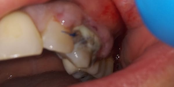 An intraoral image of a post-operative infection. There is severe pain and swelling after the surgery. Bacteria were able to proliferate within the surgical site. The site was drained, and the patient was put on antibiotics to resolve the issue.