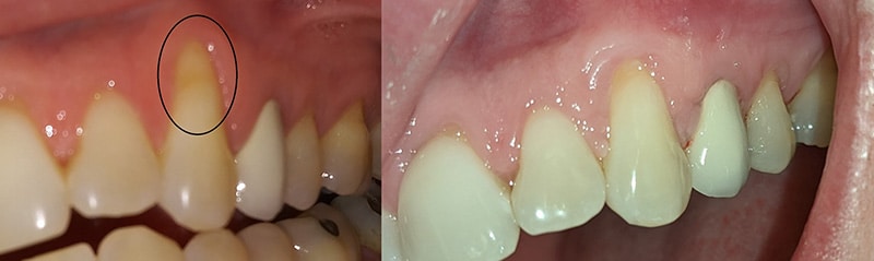A combined pre and post-op photo of a CTG on tooth #11. A significant amount of recession on #11 had taken place. After surgery and healing, there was a marked improvement in the recession. While the was a considerable improvement, the recession was not completely reversed. This patient would require additional surgery, including bone grafting, for full resolution.