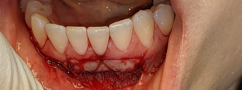 Post-surgical photo depicting a free gingival graft. The surgical site is prepared via a split-thickness flap, and a rectangular piece of tissue is harvested from the palate and sutured. Then the area is left to heal, resulting in significantly improved gingiva.