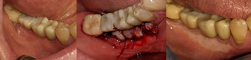 Intraoral images preop, during surgery, and post op of a FGG around an impant supported bridge on sites 28-30. Prior to surgery, there is a poor, non-keratinized tissues around the bridge. This makes the bridge more susceptible to failure due to bacterial ingress.