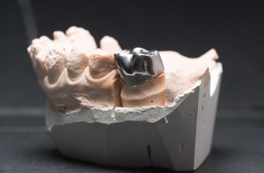 A picture of a tooth mold showing a metal crown.