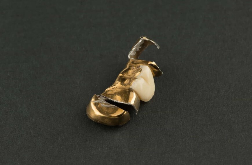 A picture of a broken metal crown that has been removed.