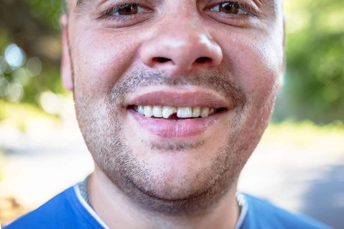 A picture of a man with a broken tooth.