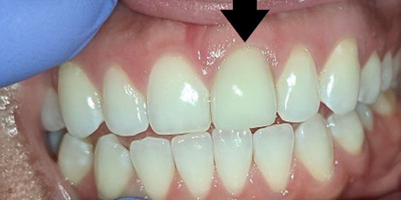 A photograph of a single anterior crown on the patients maxillary left central incisor. It is very difficult to be able to absolutely hide a single crown, however this crown is difficult to spot.