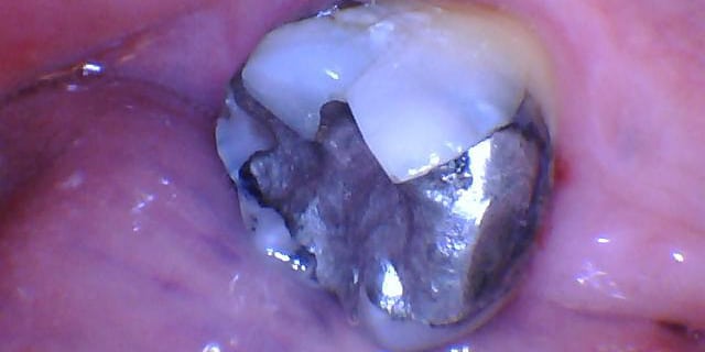 A preoperative photograph of a tooth with a very large and old amalgam restoration.