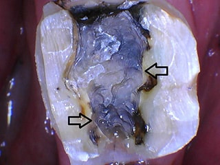 A clinical photograph of the tooth once the amalgam has been removed. Once removed, two fractures along the lingual (left arrow) and buccal (right arrow) are visible.