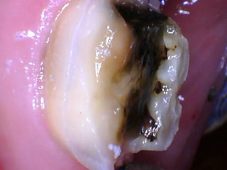 A clinical photograph with the lingual (left side) fracture partially removed. The fracture on the buccal cusp (right side) is still present.