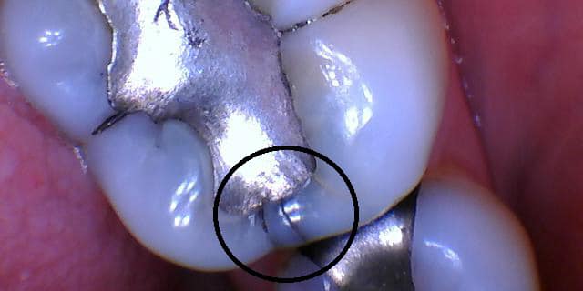 A clinical photograph of a tooth with fractures and a large amalgam filling. Marginal breakdown is present and the tooth is at risk of irreparable fracture.
