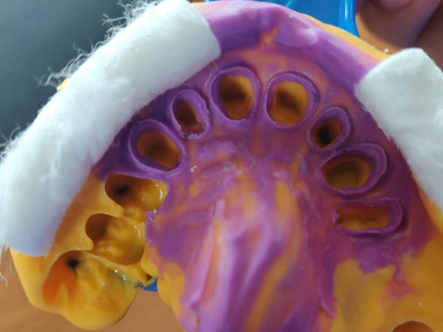 A polyvinyl siloxane (PVS) impression of an anterior crown case. The multicolor material refers to slightly different compositions resulting in varying viscosities of the material. The purple material will capture the margins of the prepared tooth better verses the orange material.