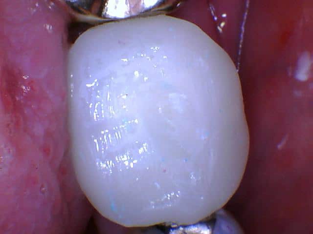 A clinical photo of a temporary crown.