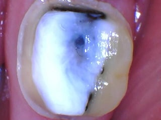 A clinical photograph of the fully prepared tooth once the fractures have been removed and a composite buildup (in white) has been placed.