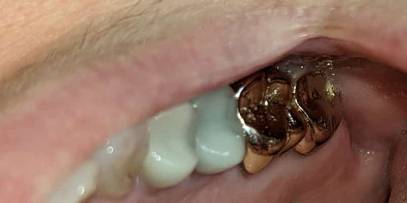 A photograph of posterior crowns in the upper left quadrant. The two posterior molars are made of a gold alloy while the two premolar mesial to the molars are made of a ceramic. Due to the location of the gold crowns, they do not pose an esthetic problem.