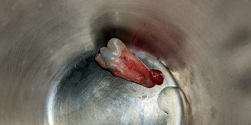 An extracted tooth which was taken out due to periapical pathology. There was a large amount of decay resulting in an abscess which was causing the patient pain. Once removed, the periapical pathology was still attached to the root. Many specialists and general dentists remove teeth regularly. The complexity and skill of the surgeon as well as the patient's health will determine who will perform the surgery.