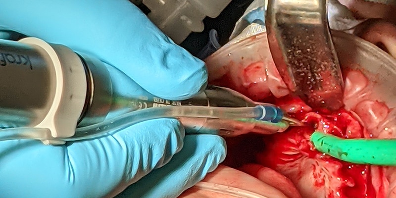 A photograph of the full arch procedure. The maxillary teeth were removed, and the bone is being profiled in this image. The patient is sedated and intubated. A temporary prosthesis will be placed upon the implants once all 6 have been placed.