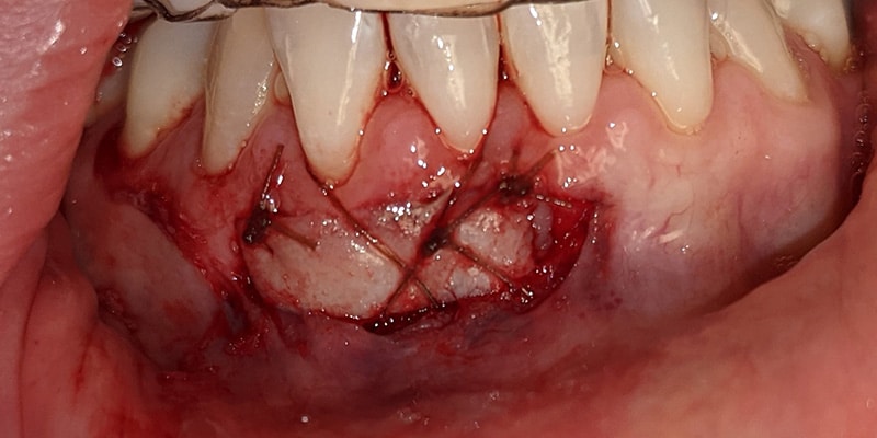 A postoperative photograph of a free gingival graft. This type of surgery utilizes donor tissue from the palate to improve the quality of gingival tissue in order to prevent further recession. This is an extremely effective procedure and improves the longterm success, especially for those with a thin biotype.