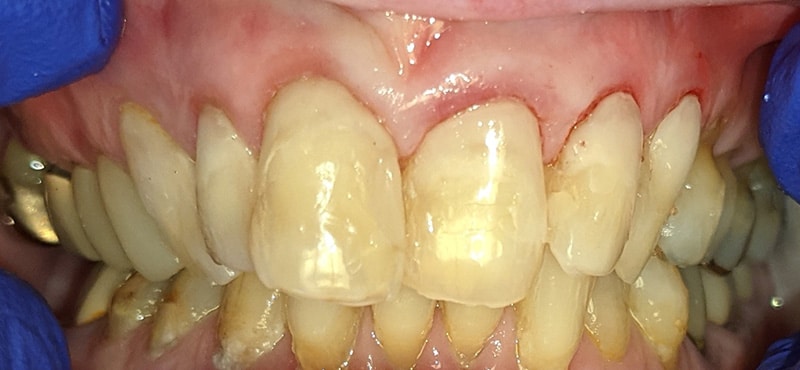 This photo shows a post operative picture of multiple restorations. After proper removal of old restorations and necessary tooth structure, the removed tooth was replaced with a combination of different dental materials. In this instance a resin modified glass ionomer as well as traditional resin composite was used. Although not as esthetic as veneers, the patient was very happy with the end result.