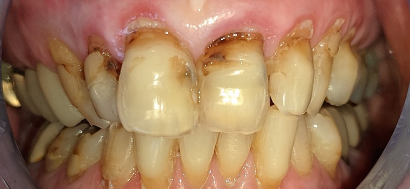 This photo shows an elderly patient who did not like the way her teeth appeared. Dental decay, abfractions, as well as old dental restorations, are visible. After reviewing treatment options, she opted for fillings as veneers were too expensive.