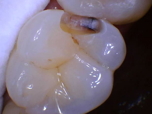 This intraoral photograph depicts dental decay. The decay has penetrated through the enamel and has reached the dentin. Once this occurs, the decay must be treated. In this instance, a conservative slot preparation was made, and a composite filling replaced what was removed.