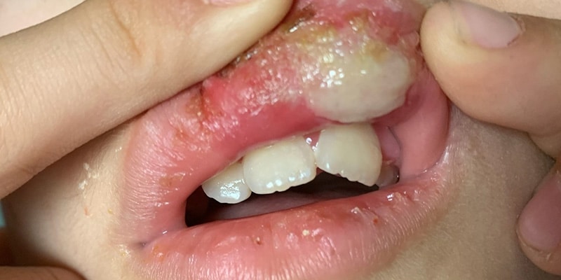A damaged lip caused by biting due to anesthesia in a young patient.