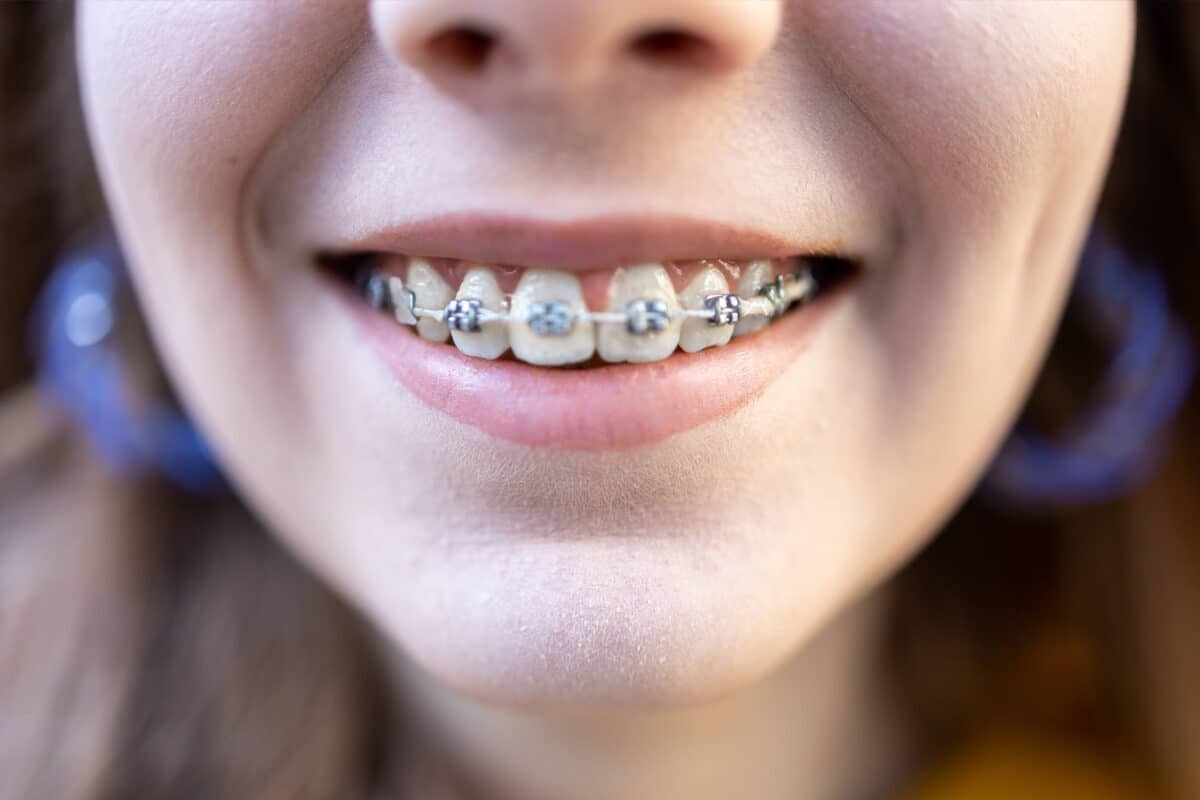 A picture of a young lady with braces.