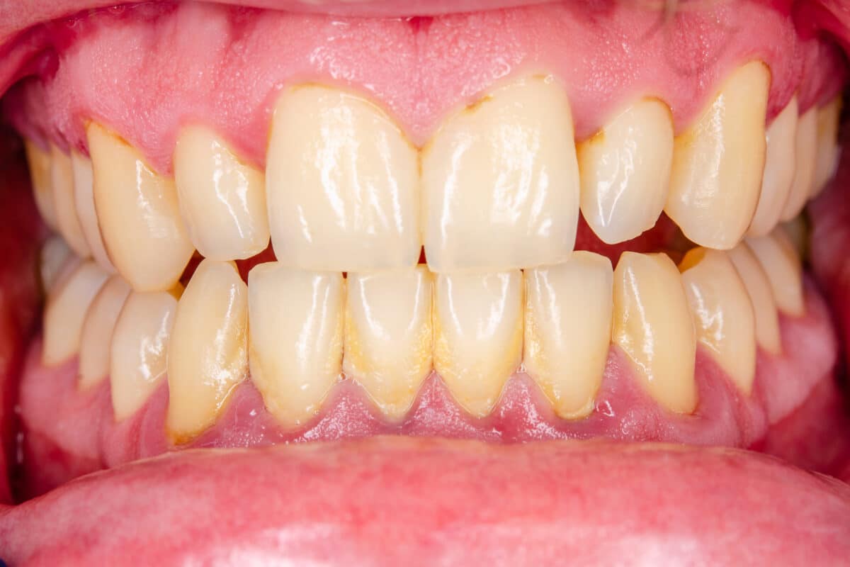 A close-up of a mouth with gingivitis