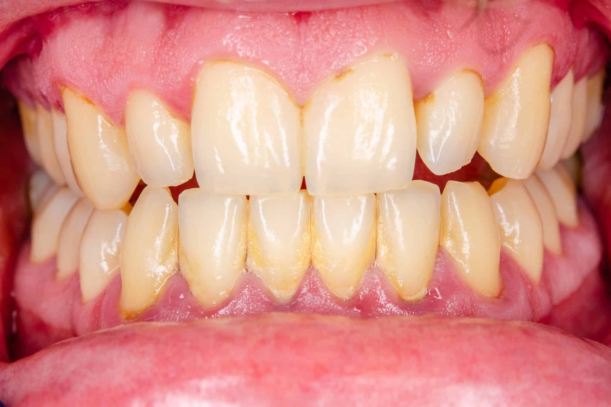 A close-up of a mouth with gingivitis