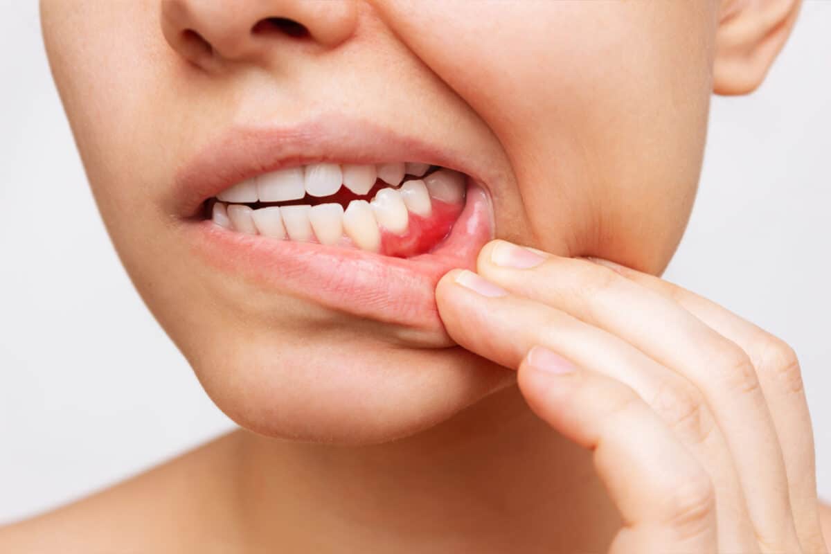 A picture of a woman showing her gums that are currently inflamed.