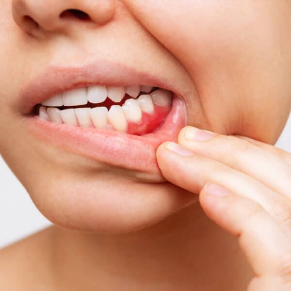 A picture of a woman showing her gums that are currently inflamed.