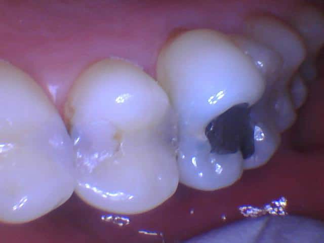 An intra oral photograph of the occlusal view of recurrent caries on existing composite restorations. Marginal breakdown and dark shadowing is visible.