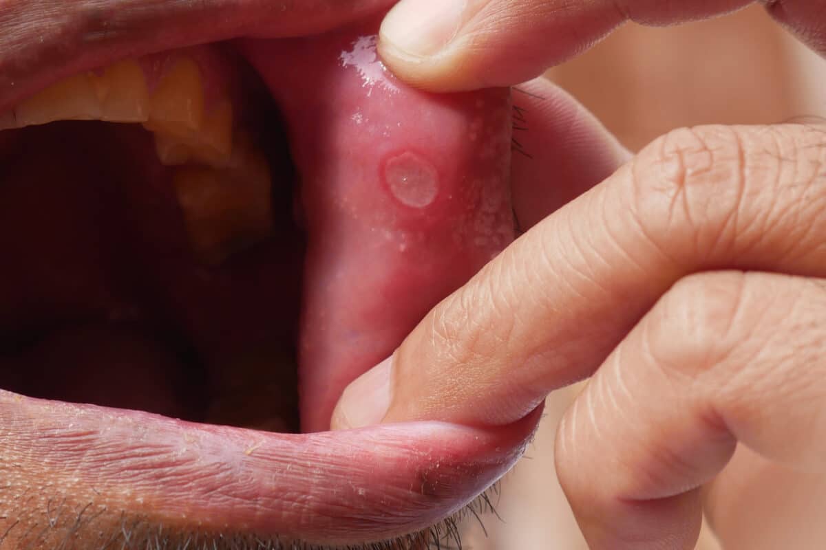 A photograph of a person showing a mouth ulcer in his mouth.